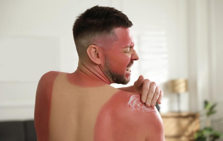 Mann mit starkem Sonnenbrand schmiert sich am Rücken ein