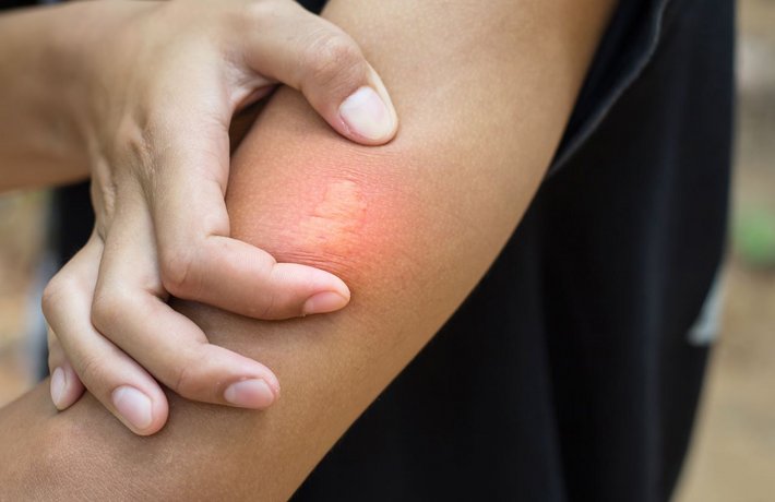 ©weerachaiphoto - stock.adobe.com Bienenstich-Reaktion auf dem Arm.